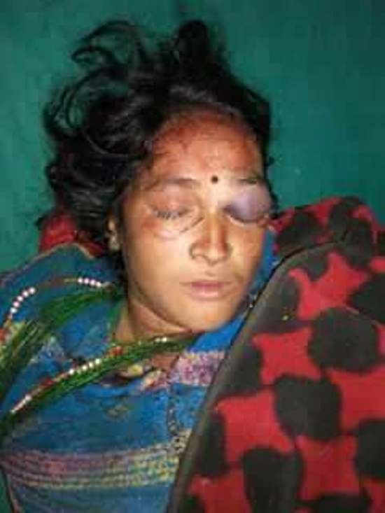 काँग्रेस र माओवादी कार्यकर्ता बिच झडप, गम्भीर घाइते कल्पनालाई उपचारका लागि नेपालगञ्ज लगियो 